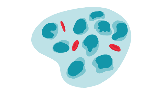 Die Illustration zeigt die Blutbestandteile rote und weiße Blutkörperchen. Dabei sind die weißen Blutkörperchen deutlich vermehrt und nicht mehr funktionsfähig. Dadurch wird die Blutkrebsart Leukämie verdeutlicht.
